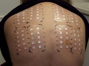 Voorbeeld van een plakproef ook wel plaktest genoemd op de rug